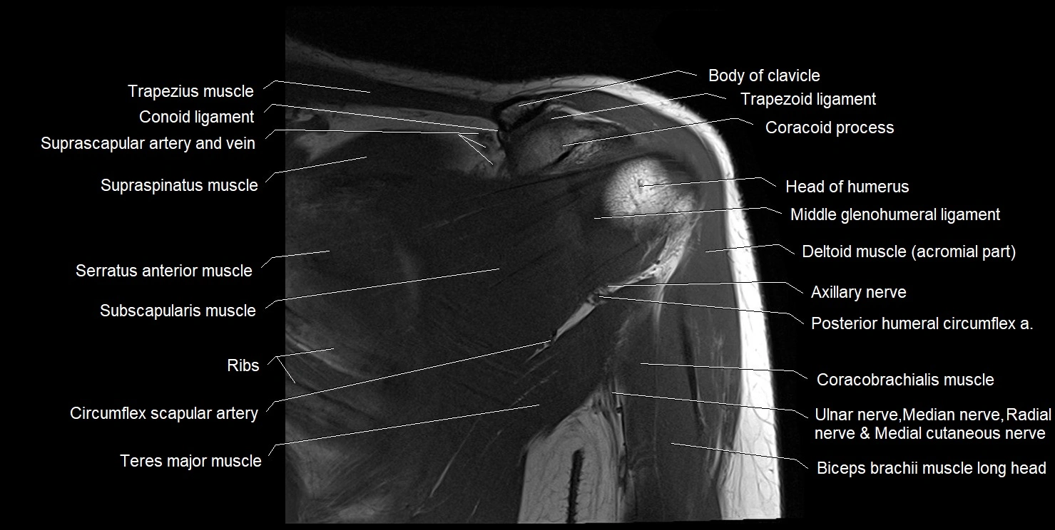 mri shoulder coronal cross sectional anatomy image 7.webp